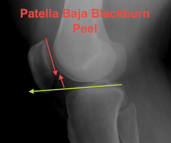 Patella Baja Blackburn Peele